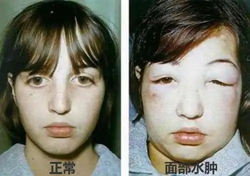 肾病眼睑浮肿图片