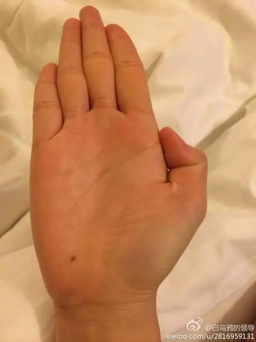 是啥意思阿?这个手心痣是初中开始长的?