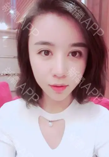 亲们,我来更新了,脂肪全脸填充一个月了,存活率非常_圈子-新氧美容