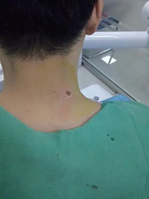 肩上扛痣,真的会压运吗?