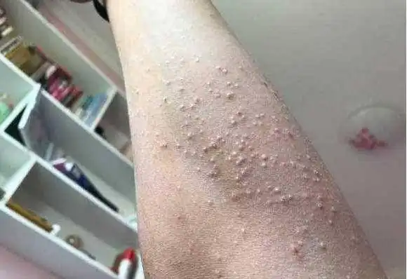 男性疥疮图片51