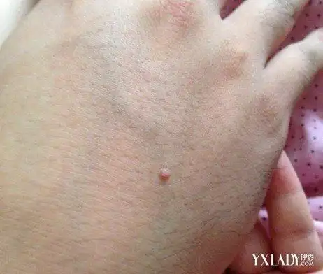 皮肤上长小肉疙瘩是为何 教你几个应对的方法