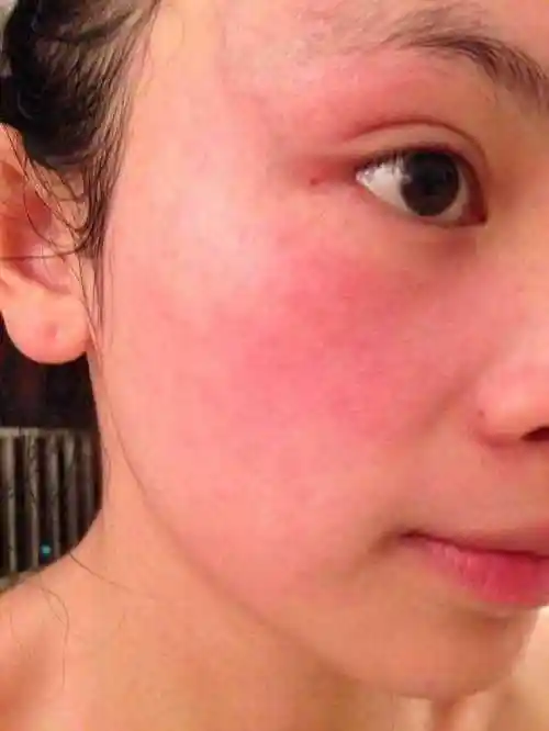 皮肤换季过敏的表现三,干性皮肤的人到这个时候脸部常常容易脱皮,还