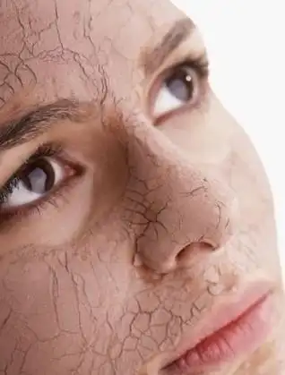 大多数人在冬季会出现皮肤干燥的状况.