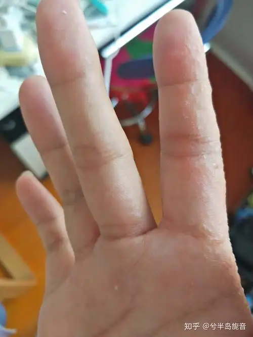 2020年我的湿疹汗疱疹治疗之路