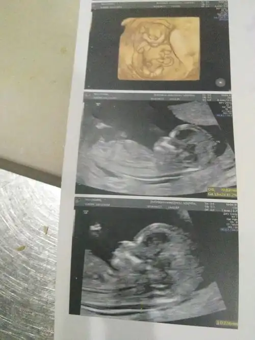 孕妈健康!nt三个亮点是男孩女孩"灯火辉煌"-第2张图片-凝残月网