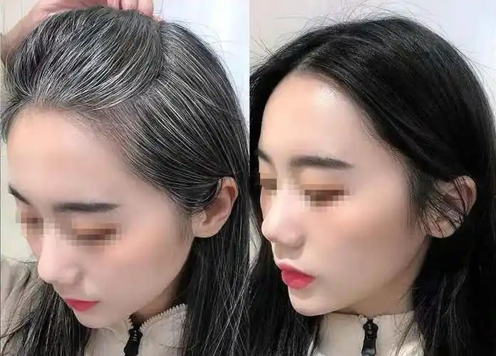 原创七年白发变黑发亲身经历看完少走弯路