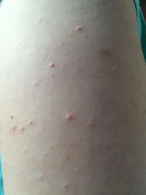 手臂上很多这样的小痘痘,背上也有,不疼不痒好几年了,最近越来越严重