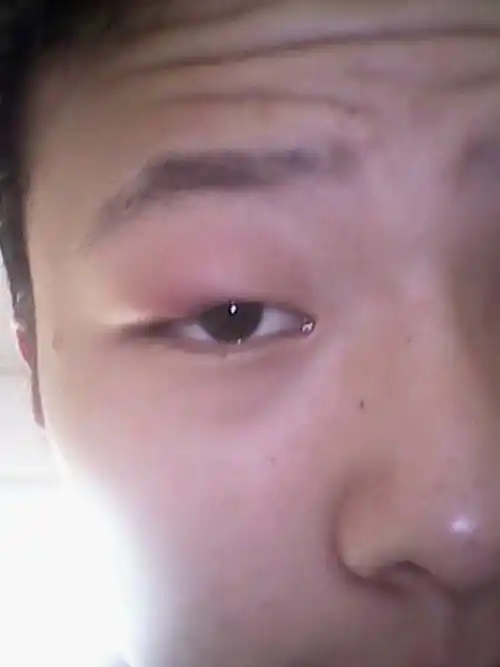问:眼睛肿成这样,怎么回事啊,需要吃什么药吗?