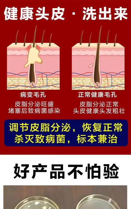 毛囊炎沐浴i露头皮毛囊焱炎脂溢性皮ii炎洗发水去屑止痒红i斑痛脓包