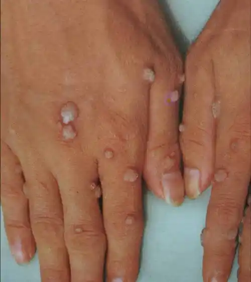 丝状疣怎么治疗女性脖子丝状疣会自愈吗