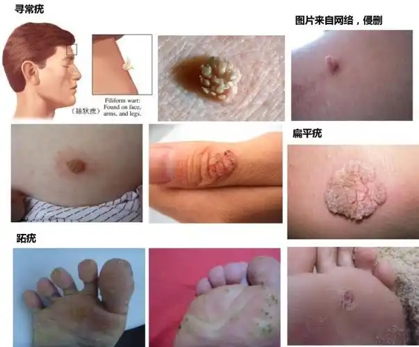 一张图教你辨别疣!常见的皮肤疣有哪些?