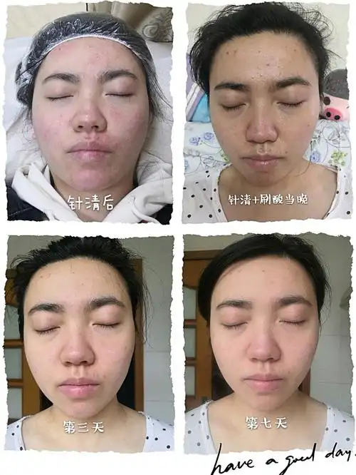 针清红光果酸换肤7天效果反馈