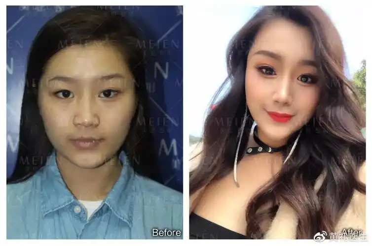 玻尿酸垫鼻梁前后对比