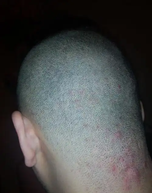 男童头皮毛囊炎康复图片_有来医生