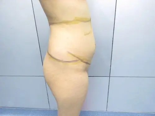 像怀孕五个月的肚子终于没有啦还是要提醒各位宝宝们抽脂后不要暴饮