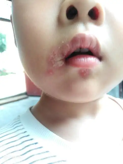 嘴角烂了,有点像水泡