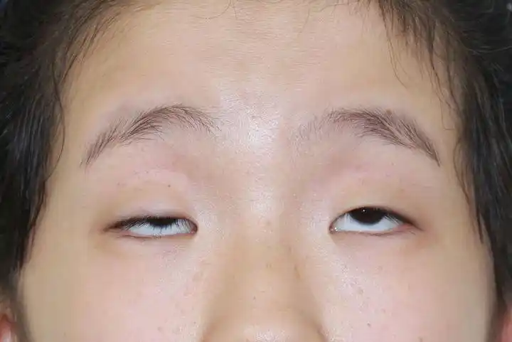 眼睑下垂大约多少钱做上睑下垂矫正手术是一种什么体验呢