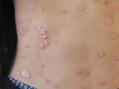 各种牛皮肤癣图片