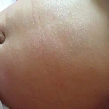 就发现膝盖处有一块硬皮,腿上有好多块,肩膀也有了,像是癣一样的东西