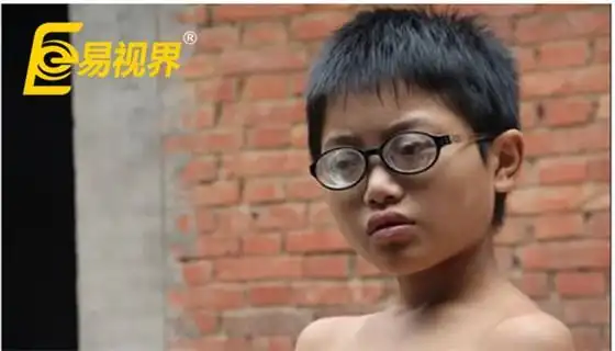 对于近视患者来说,尤其是高度近视患者,轴性近视对眼底的损伤会严重