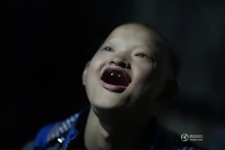 重庆15岁少年口生獠牙从小畏光