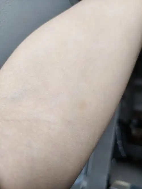 痔疮手术后第13天