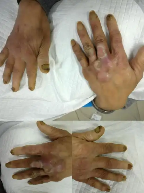 特殊感染一例(慢性溃疡讲座第20讲)