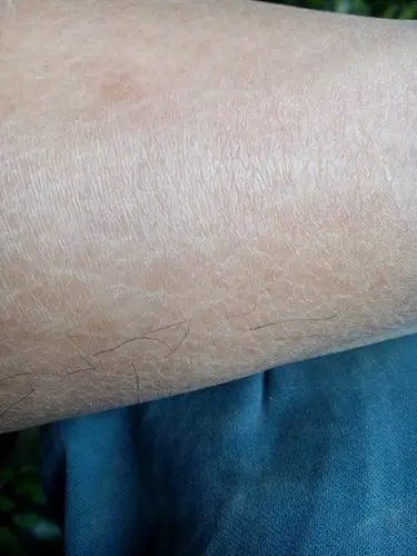 小腿上有鱼鳞斑图片9