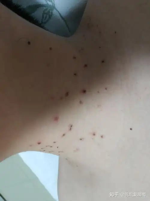 丝状疣脖子上女性医生说要激光扫有别的办法吗