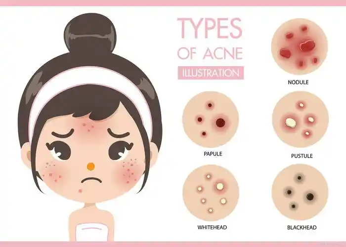 毛孔堵塞时,应该如何处理呢?塑颜工匠生活小常识