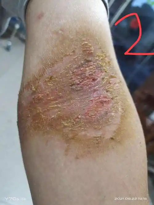 反复出现皮疹是脓皮病接触性皮炎银屑病