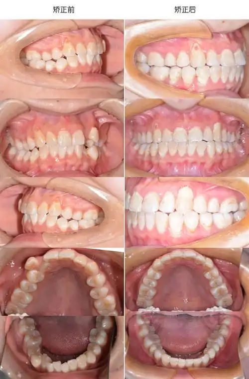矫正前后口内像对比