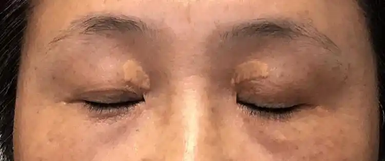 如果您的眼睛周围也有小疙瘩,不要再单纯的认为是脂肪粒,也不要自行做