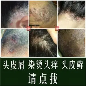 头皮真菌感染药膏