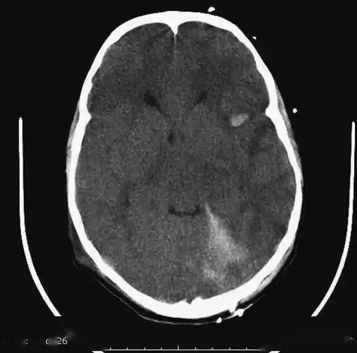 颅脑ct怎么看正常和异常影像分别是什么