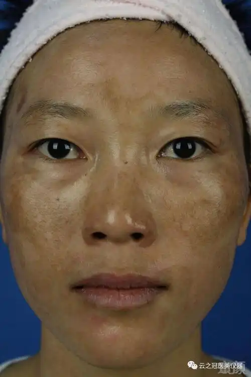 黄褐斑是皮肤界的难题在中医上叫肝斑是发生于面部的黄褐色的斑块一般