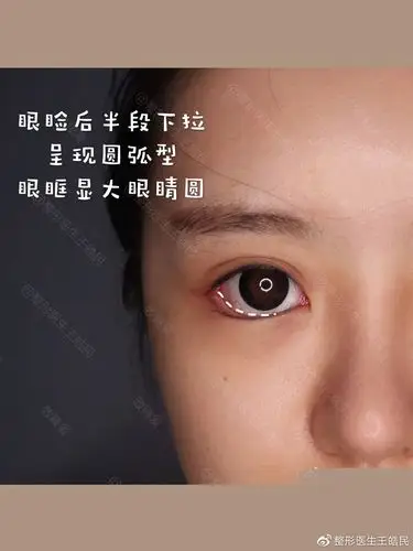 这种会显妩媚的精致型s型下至二 从瞳仁下方整体下至下眼睑 增大瞳仁