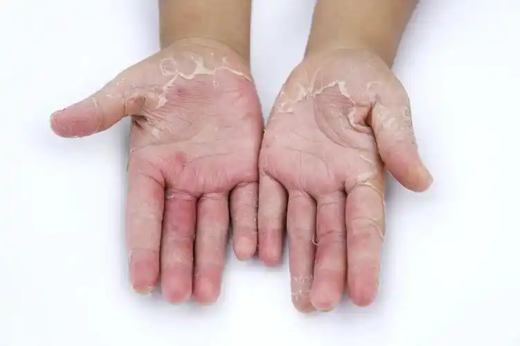 为啥一到春天手就开始脱皮发痒附带护手小妙招