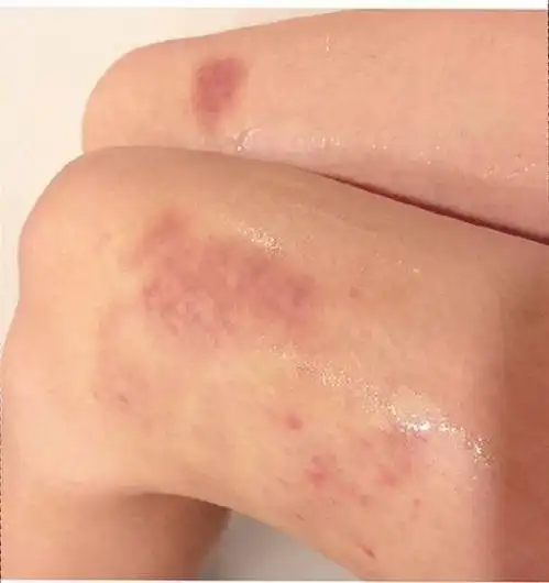 hazel腿上满是伤痕.