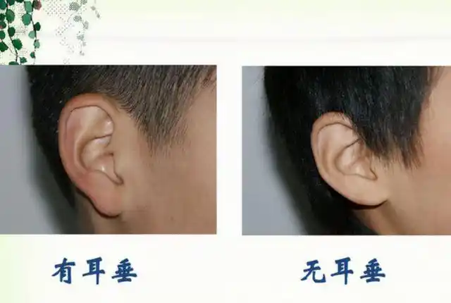 穷人耳富人耳有没有科学依据你属于哪种类型的耳朵呢