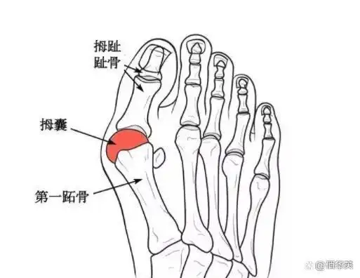 最初出现拇外翻时,大脚趾可能只是稍微出现外突,偶尔穿鞋有点疼,但是