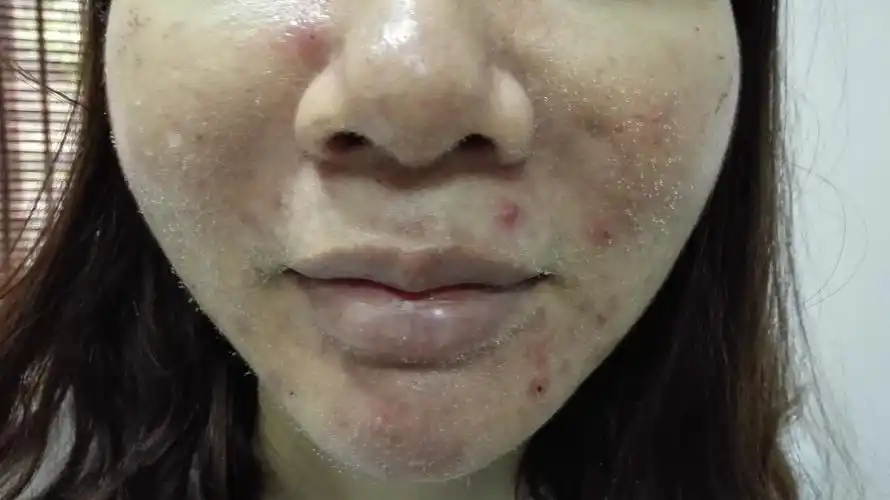 -乐活概念 祛痘加盟 祛痘加盟哪家好 专业祛痘加盟 祛痘品牌加盟