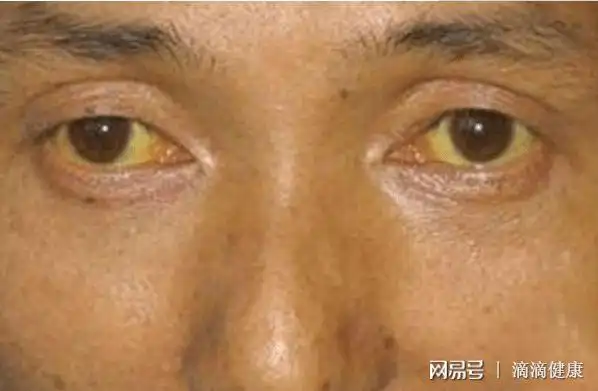 小伙查出肝癌,90天后离世,医生叹息:2件事做太多,肝迟早坏掉