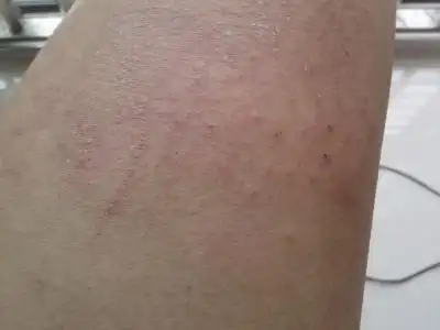 冬季皮肤干痒怎么办 保持适度凉爽