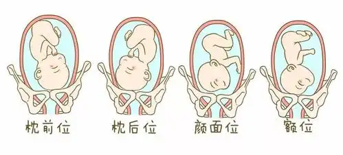 为什么会胎位不正?我该怎么办