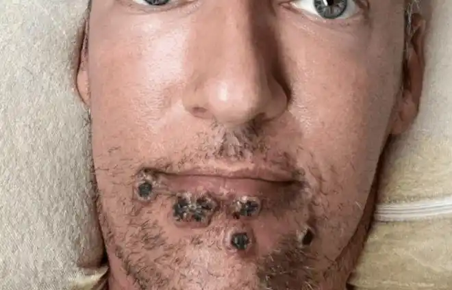 可怕猴痘患者下体溃烂肿大蔓延至79国澳洲定为全国传染病疫苗将抵达