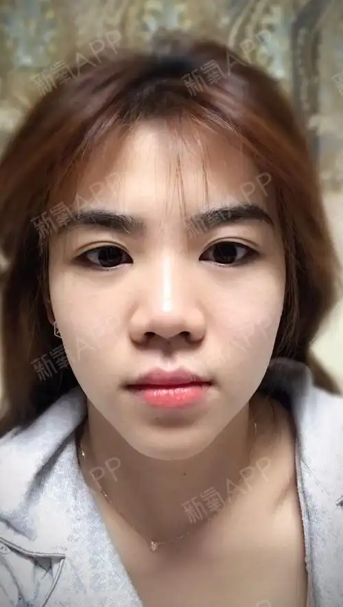 鼻翼宽鼻小柱不长鼻头不俏不挺