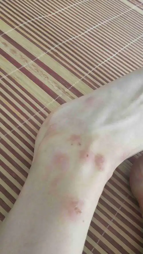 我想问一下我这个是跳蚤咬的吗,要怎么消掉(很痒)