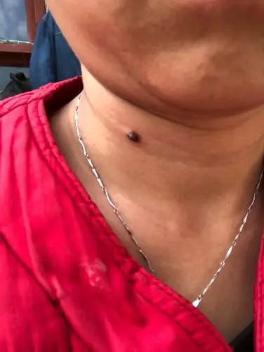 麻烦请问一下在线医生们,我脖子上这颗黑痣今天开始有点疼,感觉硬硬的